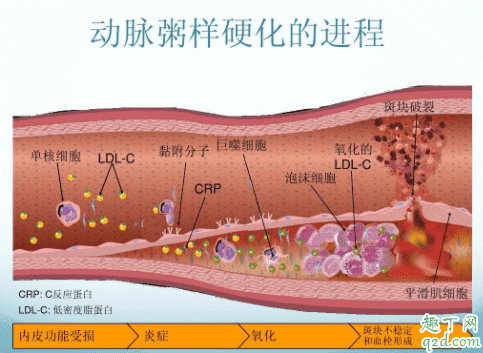 冠心病可以治療除根嗎 冠心病要做手術嗎2