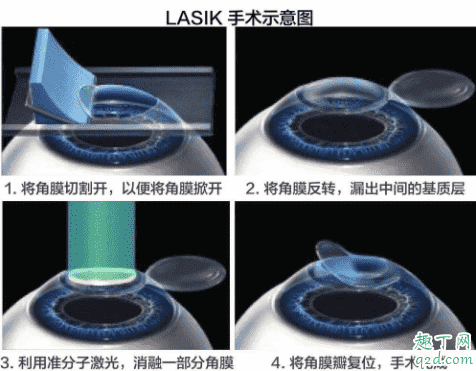 激光近視矯正手術傷眼睛嗎 眼睛近視激光會不會有后遺癥3